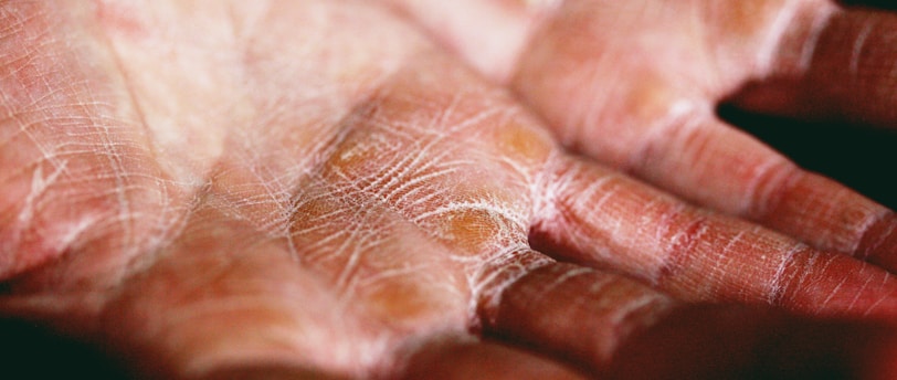 Top Brands for Holiday Dry Skin Relief: Essential Skincare Products for Winter